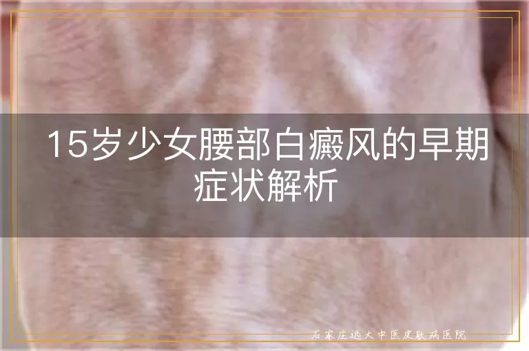 15岁少女腰部白癜风的早期症状解析