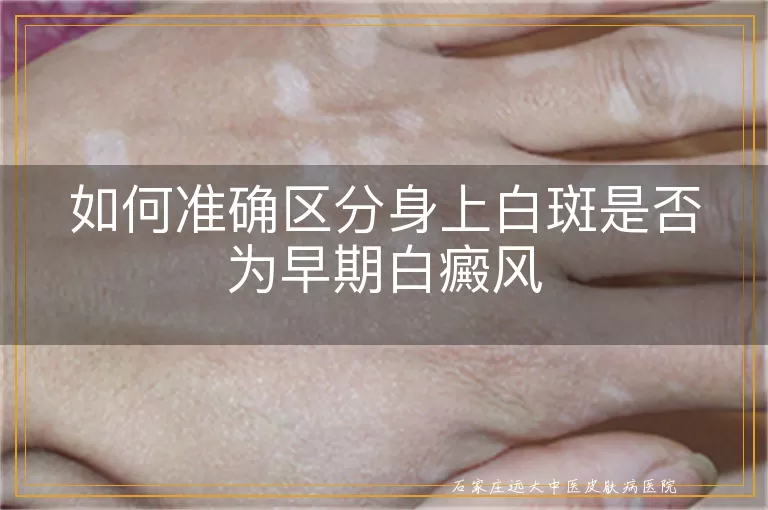 如何准确区分身上白斑是否为早期白癜风