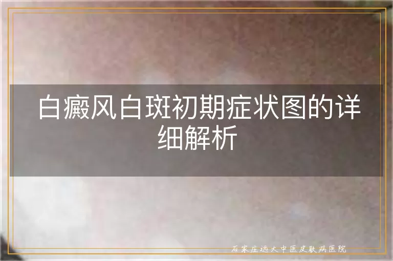 白癜风白斑初期症状图的详细解析