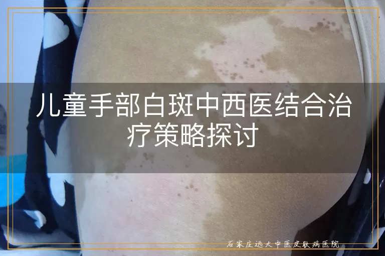 儿童手部白斑中西医结合治疗策略探讨