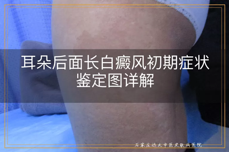 耳朵后面长白癜风初期症状鉴定图详解