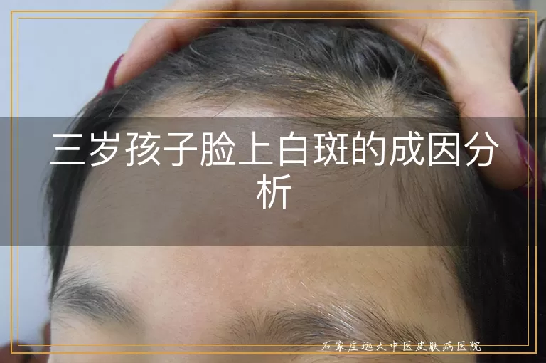 三岁孩子脸上白斑的成因分析