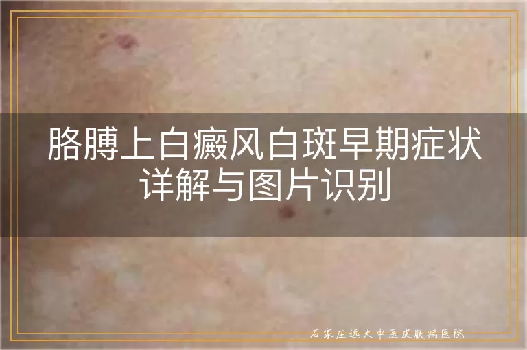 胳膊上白癜风白斑早期症状详解与图片识别