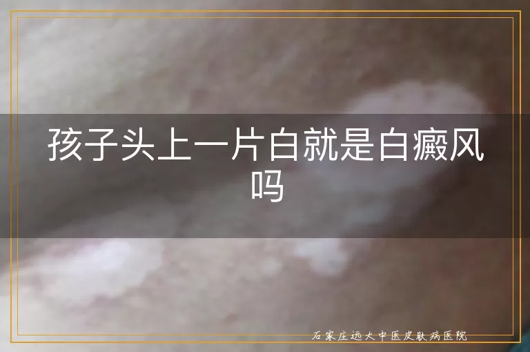 孩子头上一片白就是白癜风吗