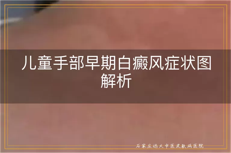 儿童手部早期白癜风症状图解析