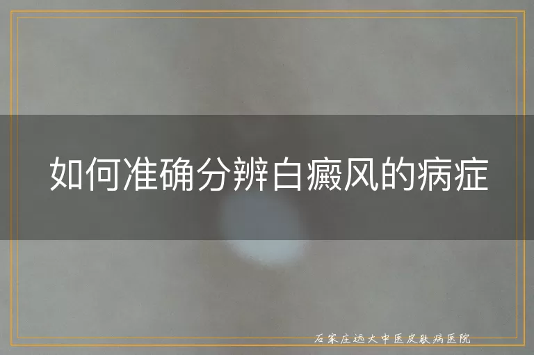 如何准确分辨白癜风的病症