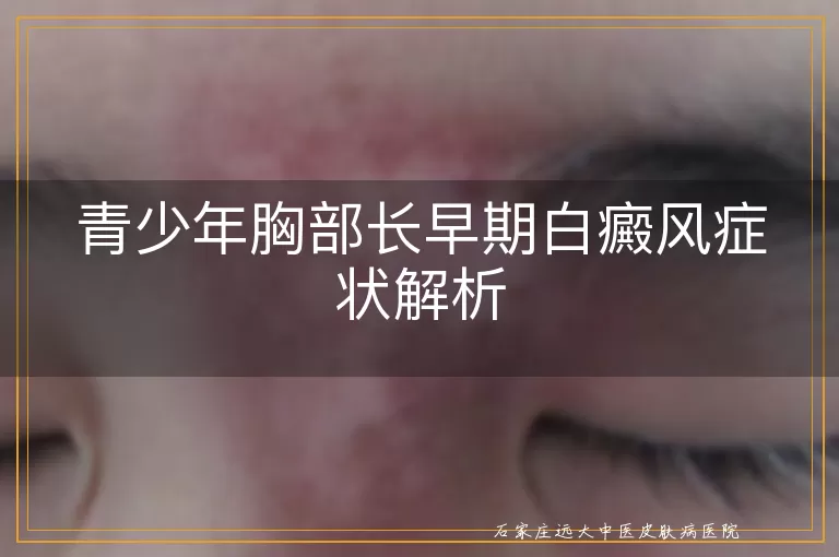 青少年胸部长早期白癜风症状解析