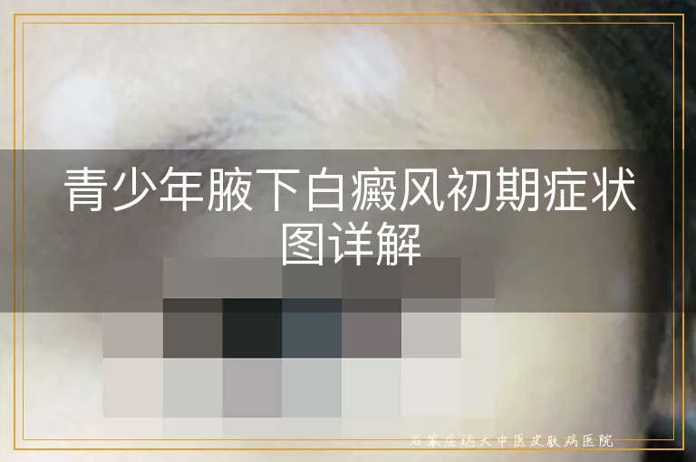 青少年腋下白癜风初期症状图详解