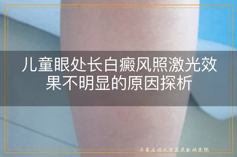 儿童眼处长白癜风照激光效果不明显的原因探析