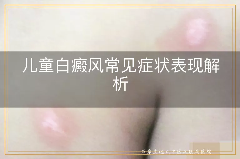 儿童白癜风常见症状表现解析