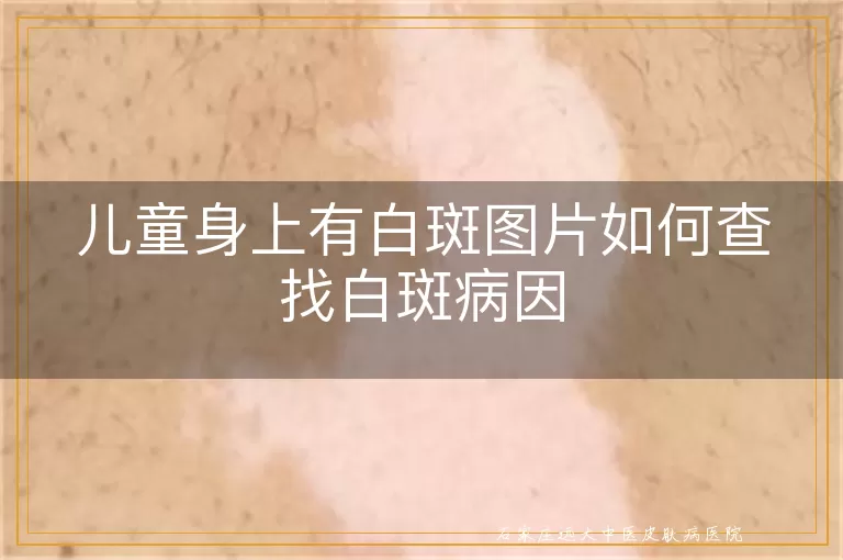 儿童身上有白斑图片如何查找白斑病因
