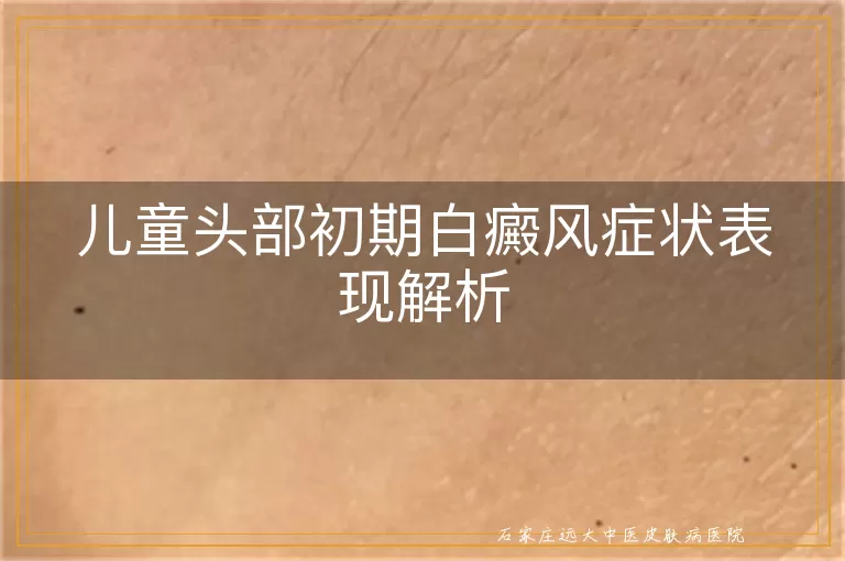 儿童头部初期白癜风症状表现解析