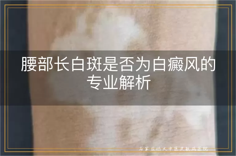 腰部长白斑是否为白癜风的专业解析