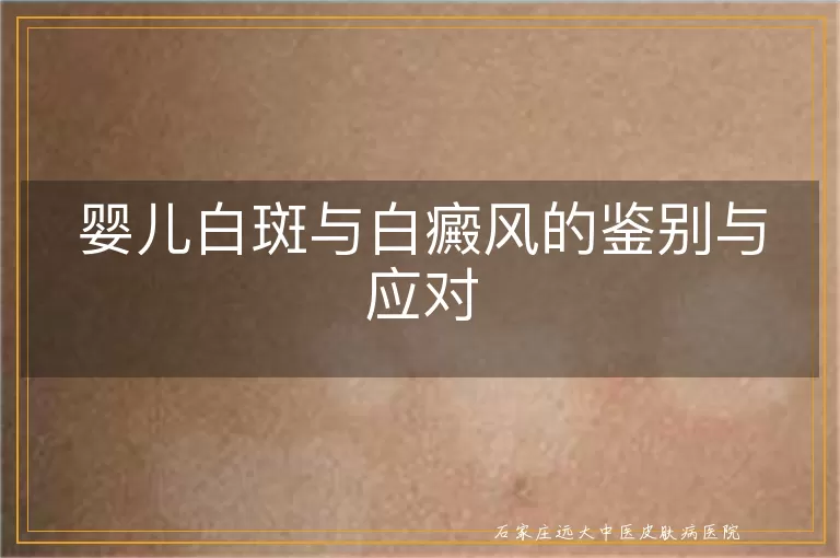 婴儿白斑与白癜风的鉴别与应对