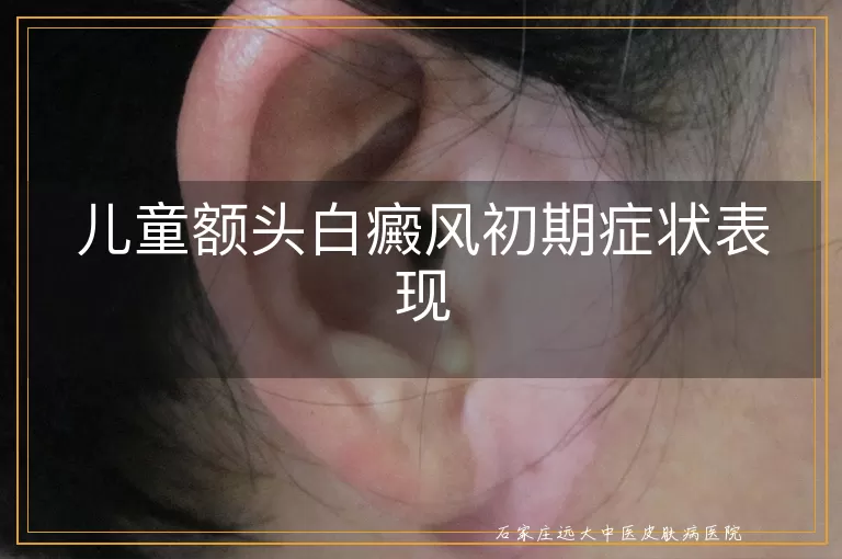 儿童额头白癜风初期症状表现
