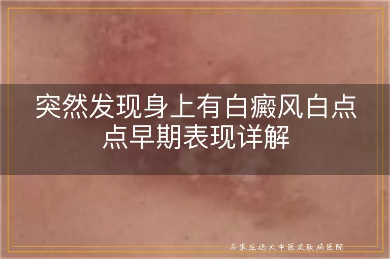 突然发现身上有白癜风白点点早期表现详解