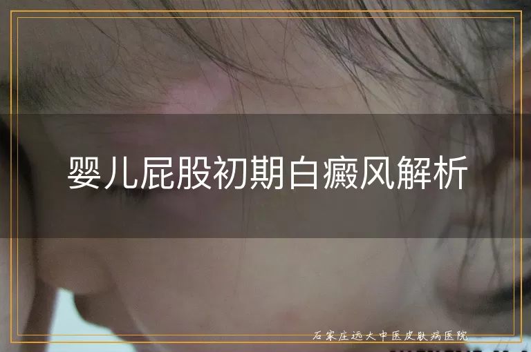 婴儿屁股初期白癜风解析
