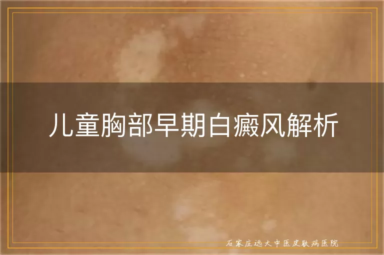 儿童胸部早期白癜风解析
