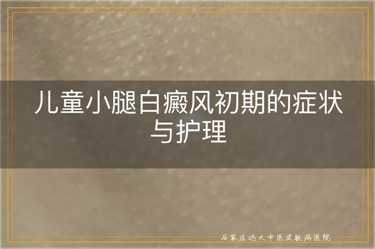 儿童小腿白癜风初期的症状与护理