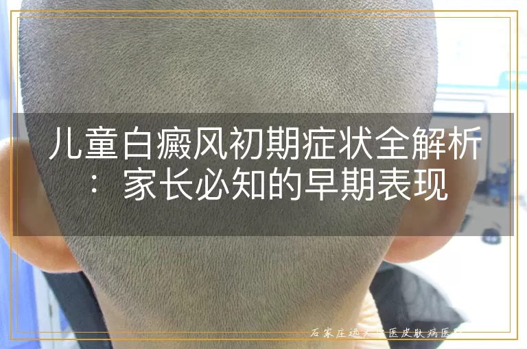 儿童白癜风初期症状全解析：家长必知的早期表现