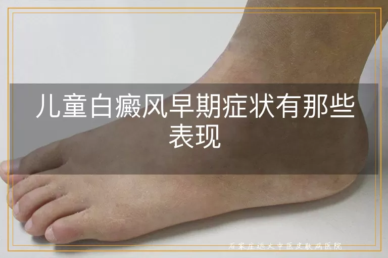 儿童白癜风早期症状有那些表现