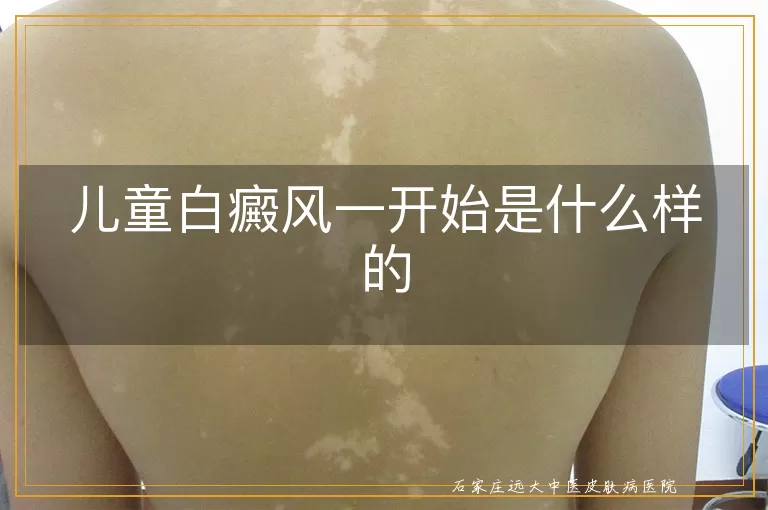 儿童白癜风一开始是什么样的