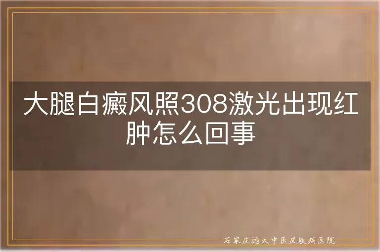 大腿白癜风照308激光出现红肿怎么回事