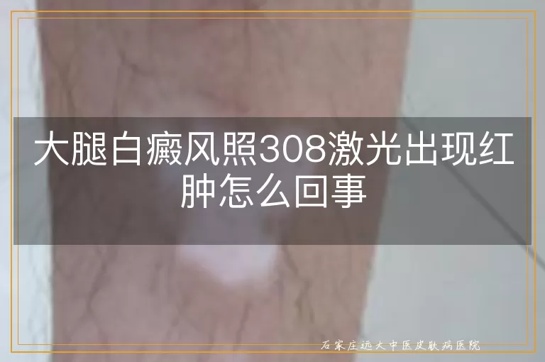 大腿白癜风照308激光出现红肿怎么回事