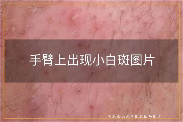 手臂上出现小白斑图片