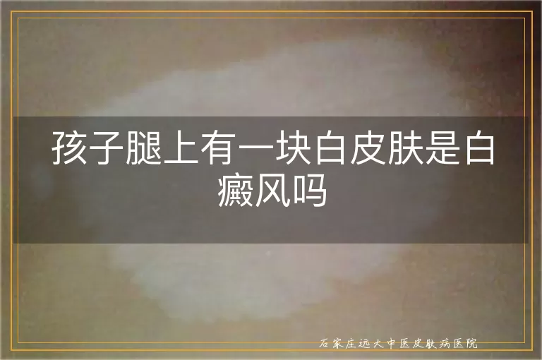 孩子腿上有一块白皮肤是白癜风吗