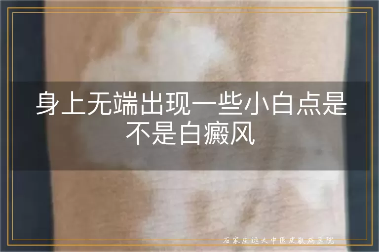 身上无端出现一些小白点是不是白癜风