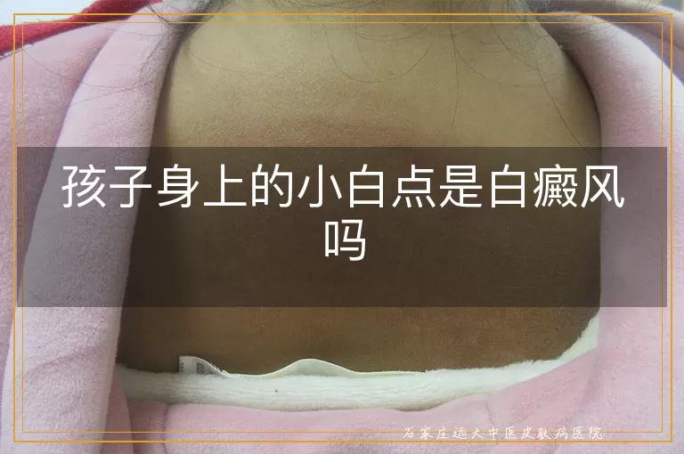 孩子身上的小白点是白癜风吗