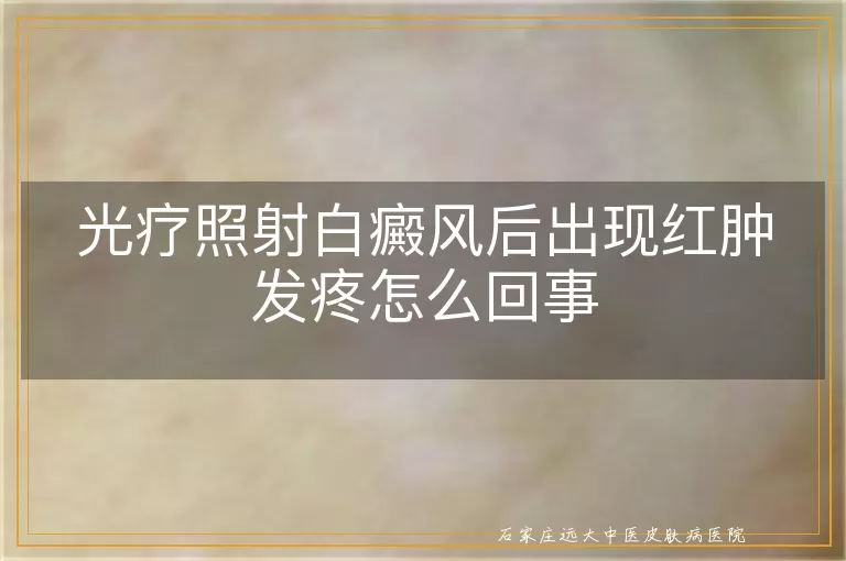光疗照射白癜风后出现红肿发疼怎么回事