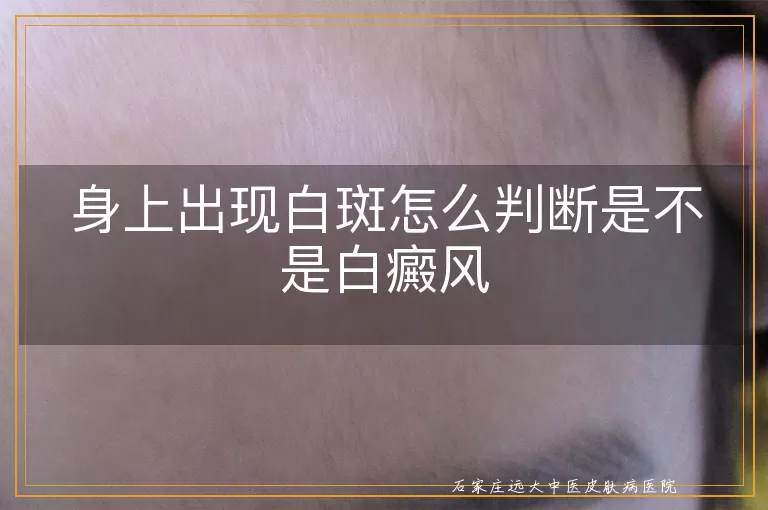 身上出现白斑怎么判断是不是白癜风