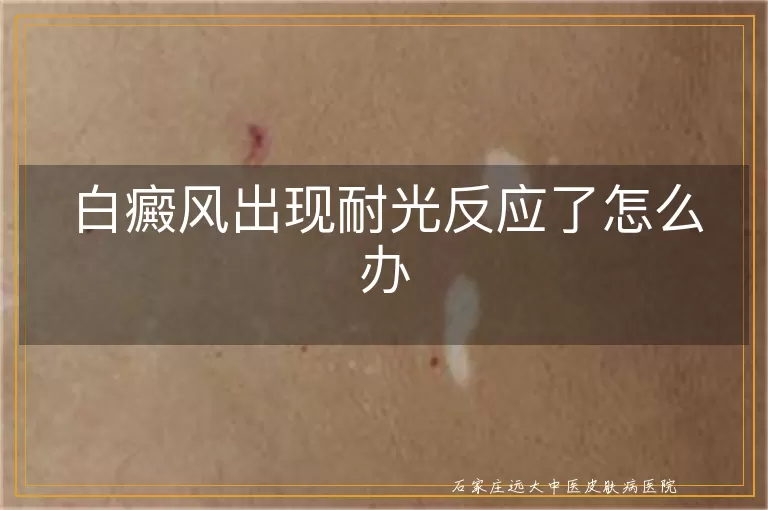 白癜风出现耐光反应了怎么办