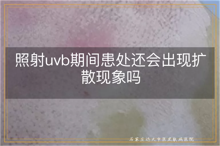 照射uvb期间患处还会出现扩散现象吗