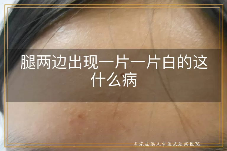 腿两边出现一片一片白的这什么病