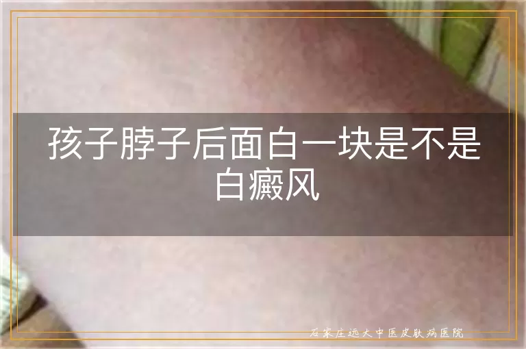 孩子脖子后面白一块是不是白癜风