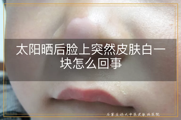 太阳晒后脸上突然皮肤白一块怎么回事