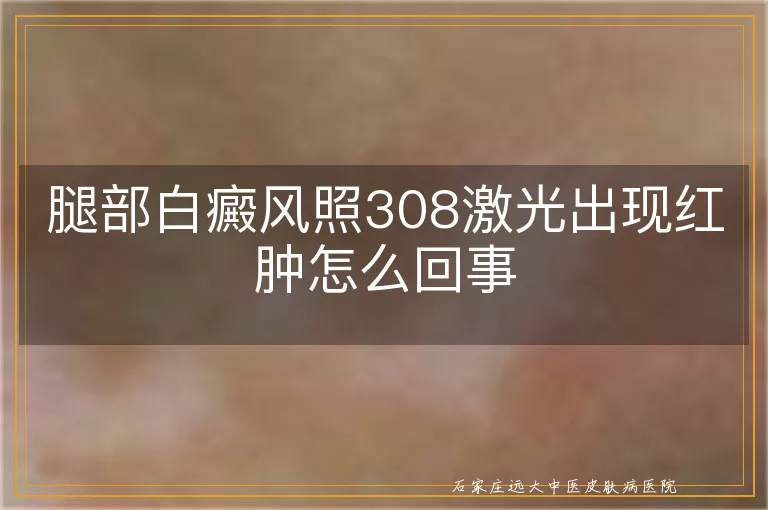 腿部白癜风照308激光出现红肿怎么回事