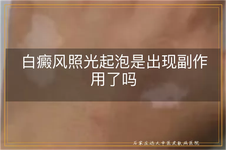 白癜风照光起泡是出现副作用了吗