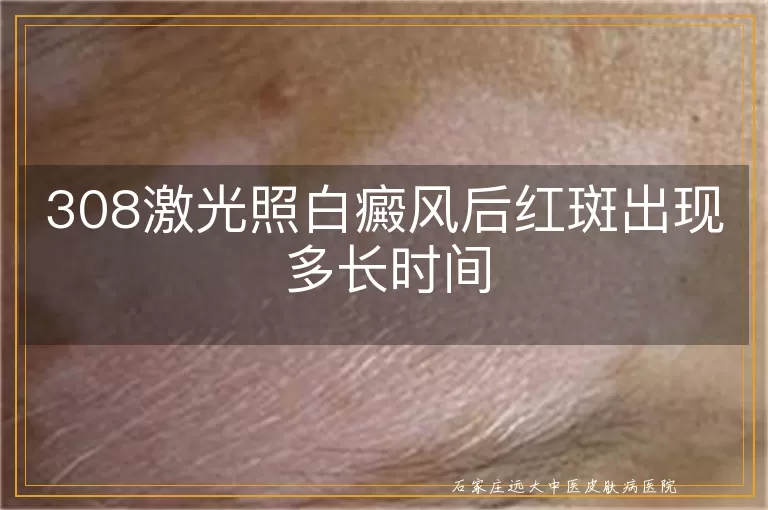 308激光照白癜风后红斑出现多长时间