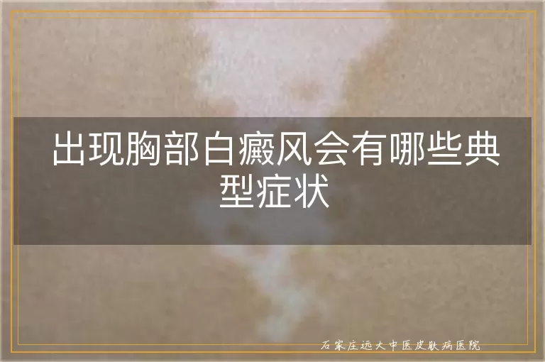 出现胸部白癜风会有哪些典型症状