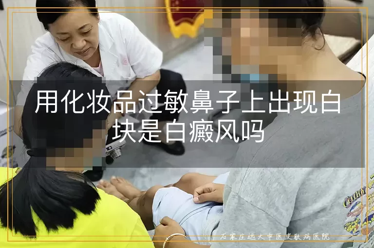 用化妆品过敏鼻子上出现白块是白癜风吗