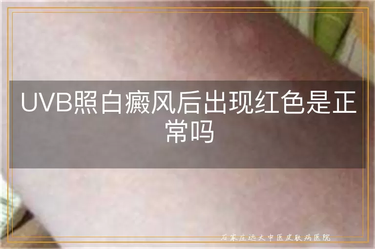 UVB照白癜风后出现红色是正常吗