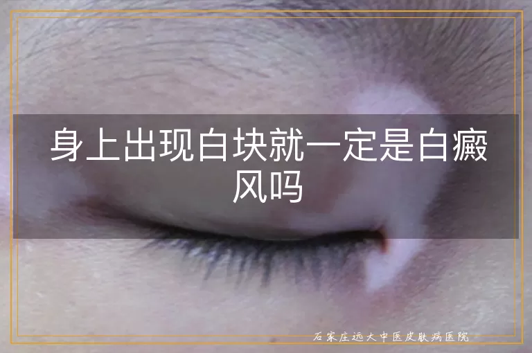 身上出现白块就一定是白癜风吗