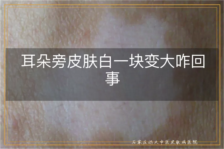 耳朵旁皮肤白一块变大咋回事