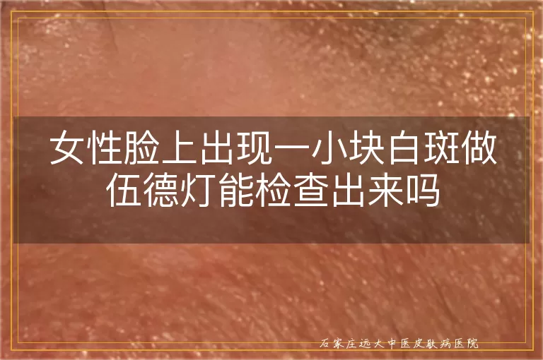 女性脸上出现一小块白斑做伍德灯能检查出来吗