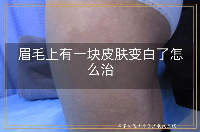 眉毛上有一块皮肤变白了怎么治
