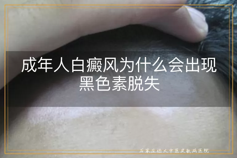 成年人白癜风为什么会出现黑色素脱失